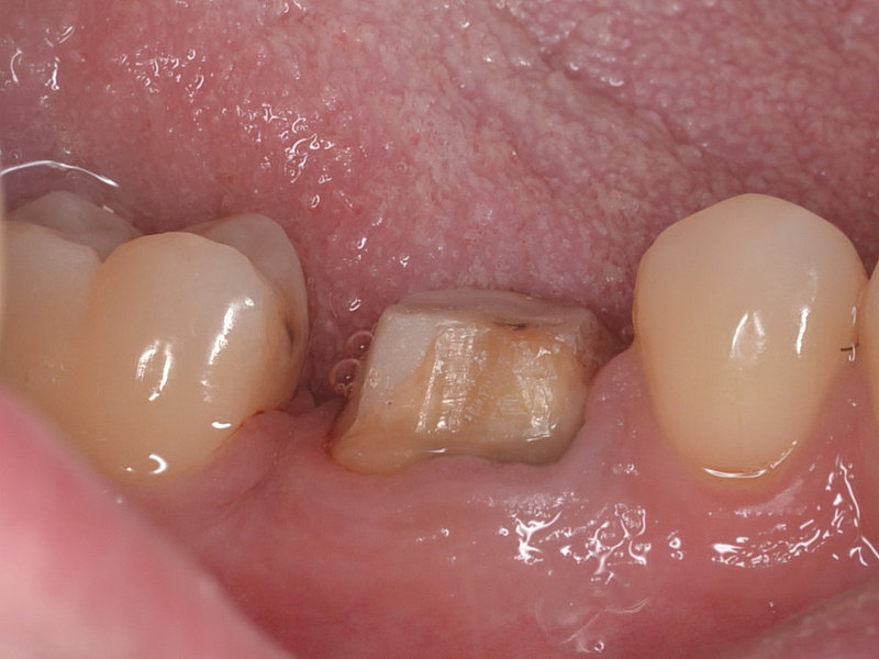 Zähne kleben lockere Ein Zahn
