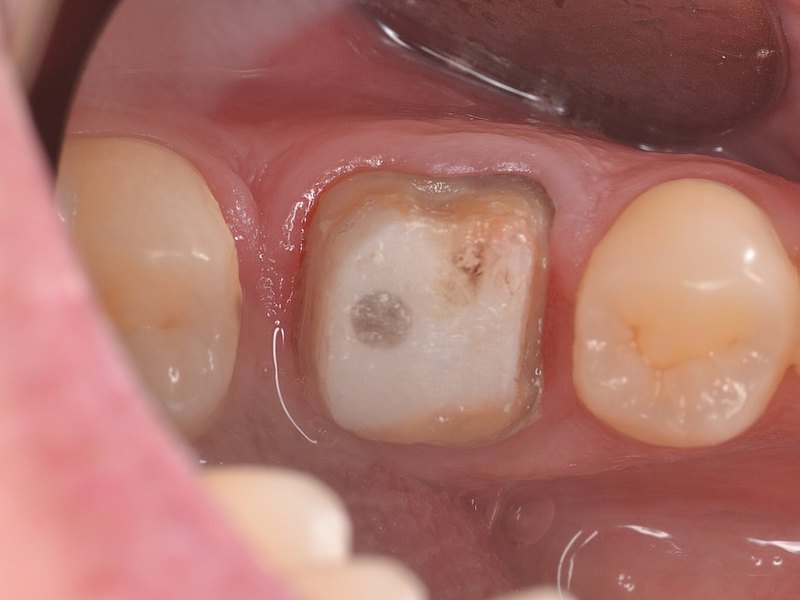Zahn halb abgebrochen